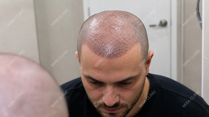 hair transplant graft care